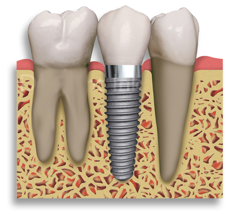 implant